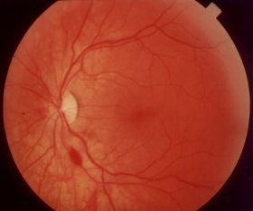linkes Auge 1. Oktober
