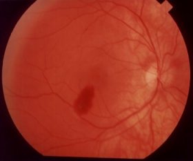 rechtes Auge 1. Oktober