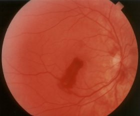 rechtes Auge 9. September